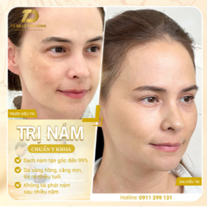 dieu-tri-nam-1